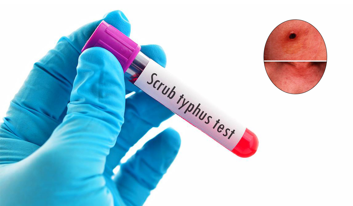 नेपालमा स्क्रब टाइफसबाट मृत्यु हुनेको संख्या १६ पुग्यो, कसरी बच्ने ?